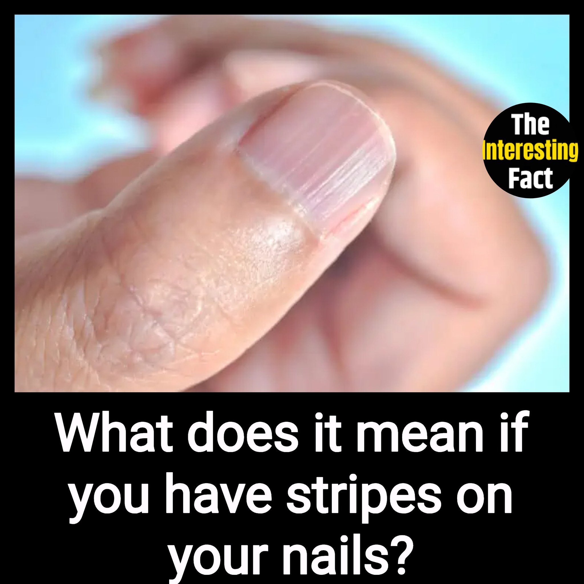 What Does It Mean If You Have Stripes on Your Nails?