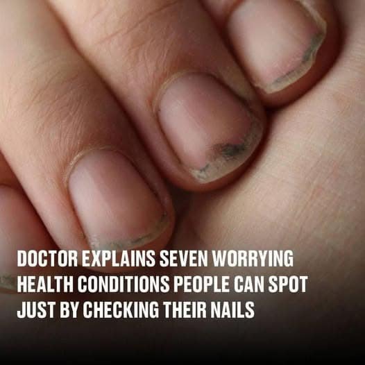 Understanding Nail Health: Key Signs and What They Mean