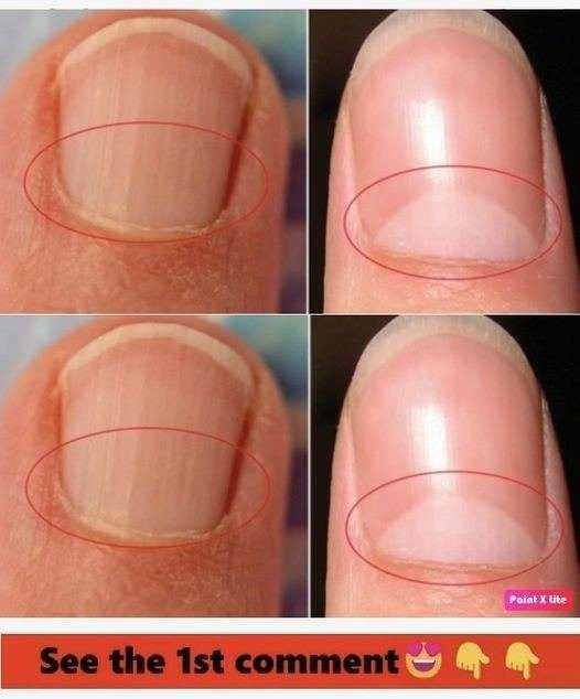 If You Don’t Have A Half Moon Shape On Your Nails, Visit A DOCTOR Immediately